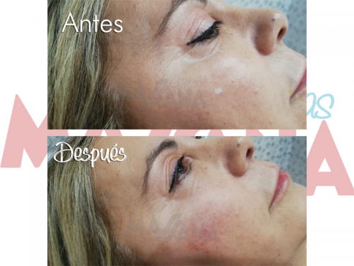 Relleno ojera �cido Hialur�nico